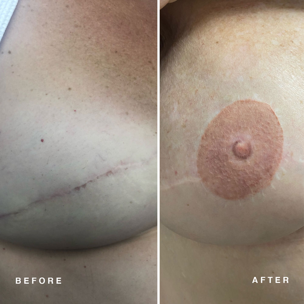3D Areola Reconstruction