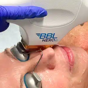 Bbl Heroic Laser
