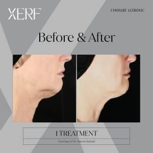 Xerf Before and After